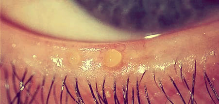 Лечение блефарита глаз в домашних условиях thumbnail