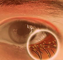 Лечение блефарита глаз в домашних условиях